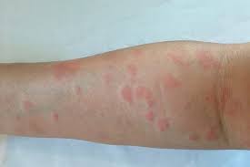 The medications most commonly used to control lupus include: Study Identifies Novel Lupus Drug Target