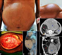 Image result for Liposarcoma