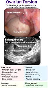 Ovarian Torsion Rosh Review Ultrasound Sonography Medical Ultrasound Diagnostic Medical Sonography