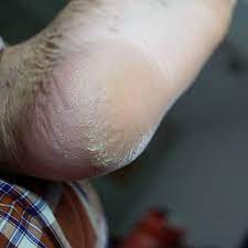• dalam bak perendaman berukutan cukup besar untuk kaki, gabungkan bersamaan jahe, minyak, dan teh hijau. Tumit Kaki Pecah Camana Nak Travel Camni Ben Ashaari