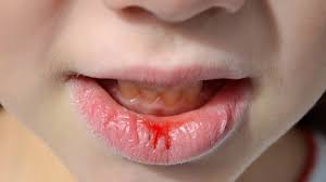 Image result for Lip Cancer