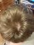 Male Hair Thinning