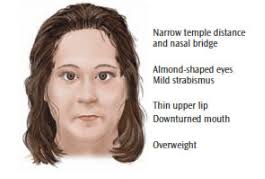 Williams (surname), a surname english in origin, but popular in wales, 3rd most common in the united kingdom. Recognize Prader Willi Syndrome Dimensions Of Dental Hygiene
