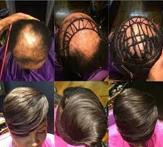More Stylists Sharing Photos Of Braid And Weave Work On Balding Clients Confidence Booster Or Bad Practice Thick Hair Remedies Alopecia Hairstyles Help Hair Loss