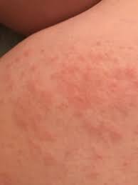 Puppp Rash November 2018 Babies Forums What To Expect