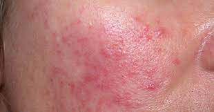 Facial Rashes What S The Diagnosis Differential Diagnoses Guidelines In Practice
