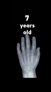 Image result for Hand Growth Plates