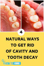 Natural Ways To Get Rid Of Cavity And Tooth Decay 112 Health And Fitness Tooth Decay Cavities Dental Decay