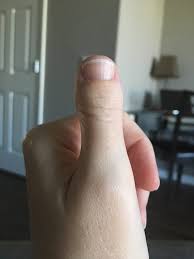 My right hand thumb is stubby. Brachydactyly Type D Is Stupid Album On Imgur