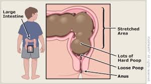 Image result for Functional Encopresis