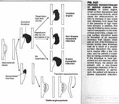 Lecture 3 Ischemic Heart Disease