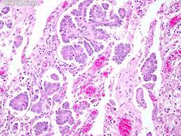 We did not find results for: Webpathology Com A Collection Of Surgical Pathology Images