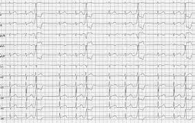 Ventrikulare Extrasystolen Fokus Ekg
