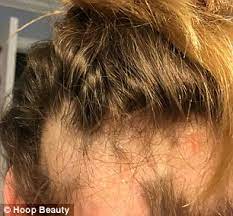 Life is definitely not fair with everyone especially with people who can grow their hair like rapunzel, while the rest there are various treatments available for hair loss, but it all comes down to how much you are willing to spend. Meet The 16 Year Old Girls Launching A Cannabis Health And Beauty Brand Express Digest