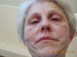 Lack of Mobility In Jaw Area After SMAS Facelift? What To Do?