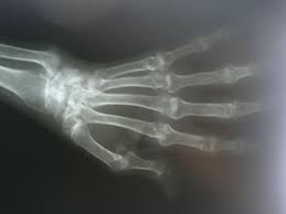 Rheumatoid arthritis (ra) is a chronic autoimmune multisystemic inflammatory disease that affects many organs but predominantly attacks the synovial tissues and joints. Rheumatoid Arthritis Hand X Ray Doccheck