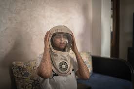 There is an impairment of the skin's ability to repair damage from ultraviolet (uv) light, leading to early skin changes, early sunburn. When Light Is Lethal Moroccans Struggle With Skin Disorder