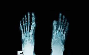 Image result for toe amputation