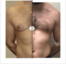 Some insurance companies do cover breast reduction surgery. Male Breast Reduction Houston Tx Gynecomastia League City Tx