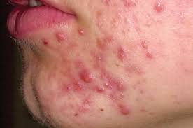 Image result for red rash face