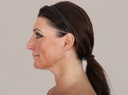 Best Gastric Plication buying in Abu