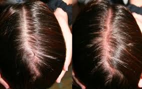 Hair Dye Burning Scalp Hair Loss Http Www Hairlossmenwomen Com Hair Dye Burning Scalp Hair Loss Thick Hair Remedies Hair Remedies Thick Hair Styles