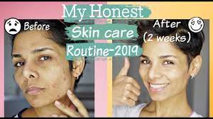 The top layer of the skin (which is uneven) is peeled off. How To Get Rid Of Acne Discoloration And Uneven Skin Tone Skin Care Routine 2019 Youtube