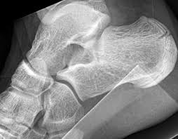 Image result for Calcaneus Compression Fracture