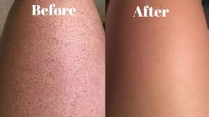 The scars can occur on any part of the body. How To Get Rid Of Strawberry Legs And Ingrown Hairs Fast Youtube