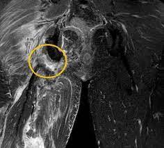 Dr henry knipe and assoc prof craig hacking et al. Hamstringruptur Hamstrings Abriss Ksw Kantonsspital Winterthur