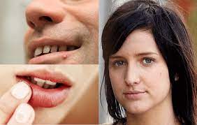 Read my story to see what worked and what changed my life. How To Get Rid Of A Pimple On Your Lip Overnight Pimples How To Line Lips Lips