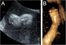 Achados ultrassonográficos bidimensionais e tridimensionais da ictiose  arlequim: relato de caso e revisão da literatura | Anais Brasileiros de  Dermatologia