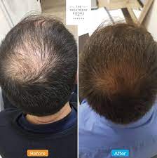 The longer you wait, the less effective results are: Male Hair Loss What You Need To Know Hair Transplant Clinic London