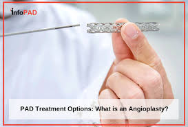 Angioplasty is a procedure to open narrowed or blocked blood vessels that supply blood to the heart. What Is An Angioplasty Learn About Pad Treatment Options