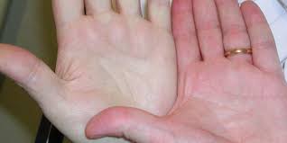 Image result for ‫کم خونی‬‎