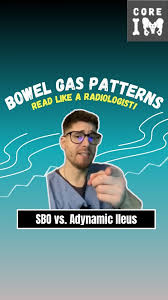 Image result for Adynamic Ileus