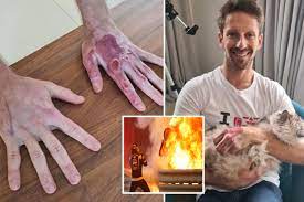 Former f1 driver romain grosjean is still affected by the burns on his hands, with promotional shots of him in a mercedes racing suit. F1 Star Romain Grosjean Shows Off Gruesome Hand Injuries As Bandages Finally Come Off Following Miracle Fireball Escape