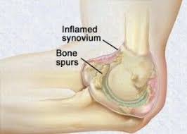 Signs And Symptoms Of Bone Spurs Bone Spurs Heel Spurs Spurs
