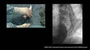 Case video: Saccular aneurysm with suspicion of contained rupture | Gore  Medical Europe