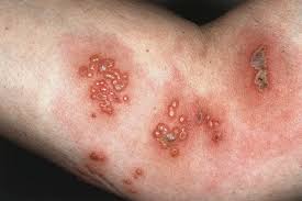 Image result for shingles