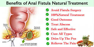 You may need treatment for a medical condition that caused your fistula. Anal Fistula Shuddhi