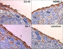The disease mesothelioma is a tumor / lung cancer of that tissue. Senescence Related Deterioration Of Intercellular Junctions In The Peritoneal Mesothelium Promotes The Transmesothelial Invasion Of Ovarian Cancer Cells Scientific Reports