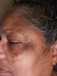 Can CPAP usage cause a stye?