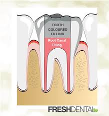 So what is a tooth filling, and what happens during a root canal? Root Canal Treatment In Huntersville Nc Fresh Dental