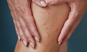 Image result for scabies in the groin area