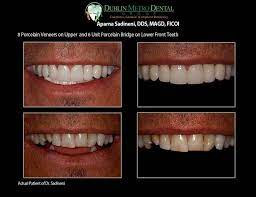 How to deep clean invisalign retainers. How To Deep Clean Invisalign Retainer Arxiusarquitectura