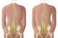 How To Kinesio Tape For Scoliosis Ehow Scoliosis Exercises Scoliosis Scoliosis Treatment