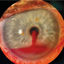 Image result for Hyphema
