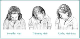 Hyperthyroidism is a condition that describes an overactive thyroid, where too much of the th3 and th4 hormones are produced. Hair Loss Due To Thyroid What You Need To Know Ak Clinics