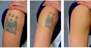 Kimyasal Peeling Dovme Silme Kremi Kotu Dovmeler Dovme Tattoo